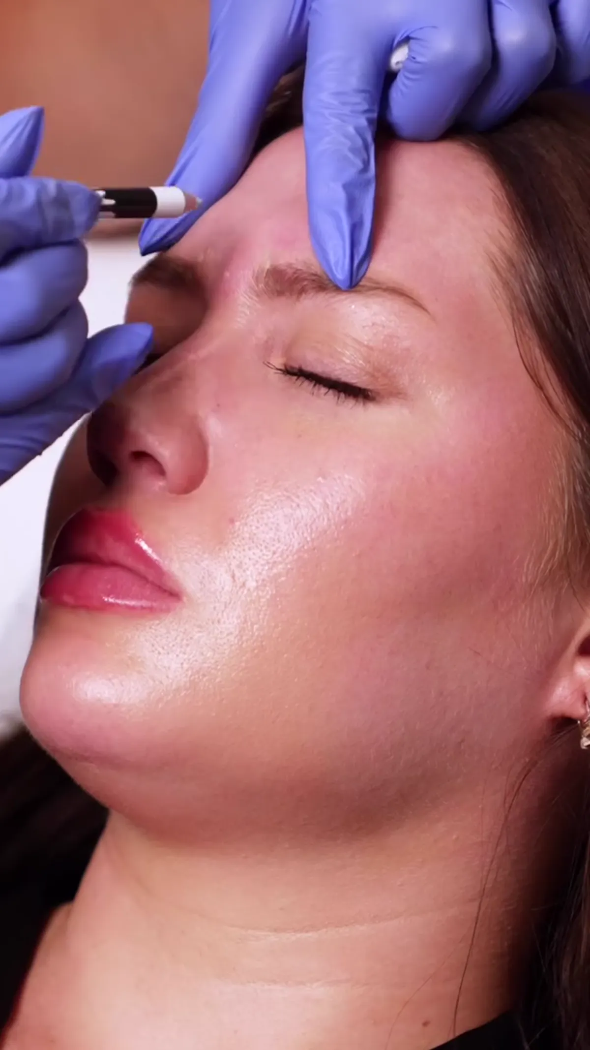 BOTOX® treatment