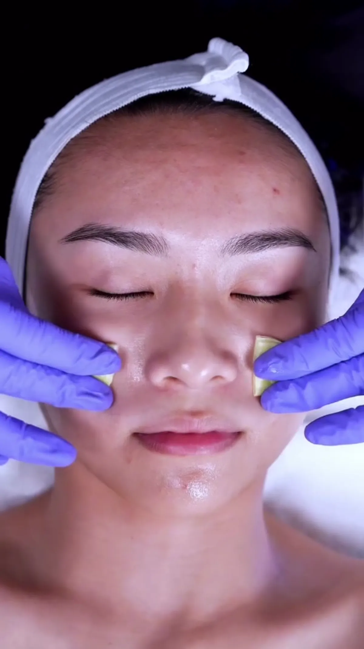 Chemical Peels treatment detail