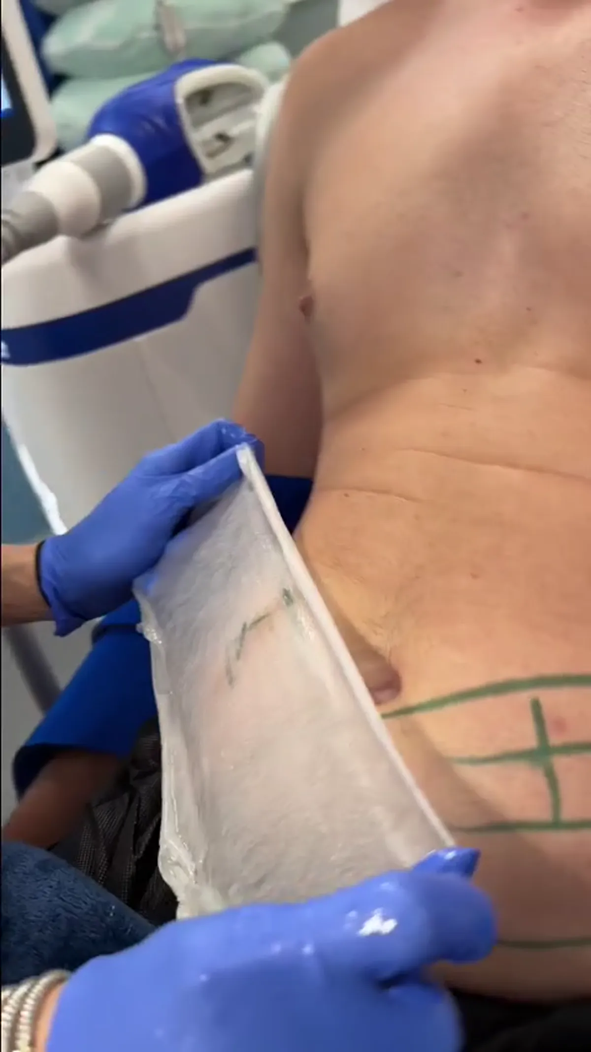 CoolSculpting treatment detail