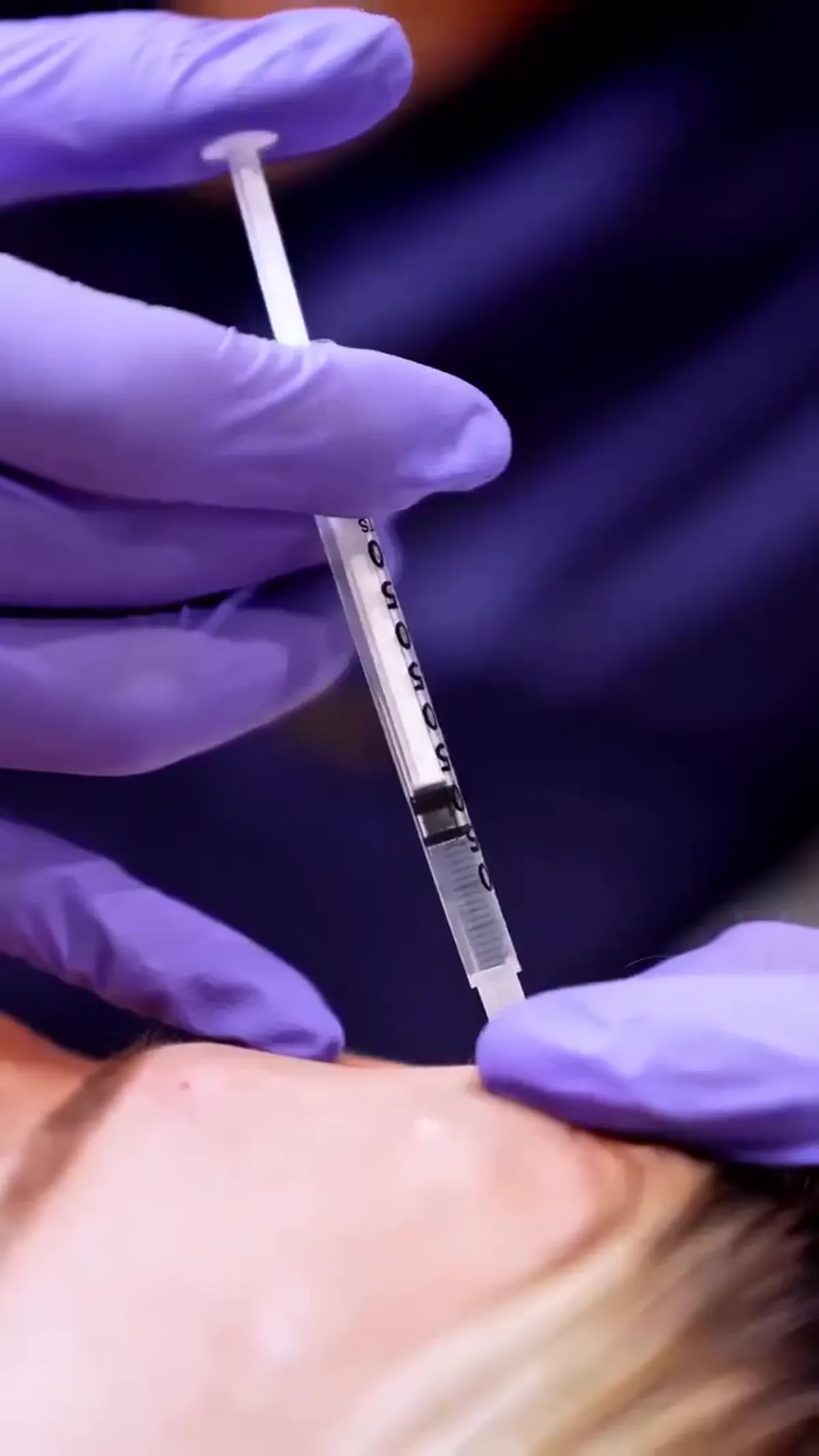 Dysport® treatment detail