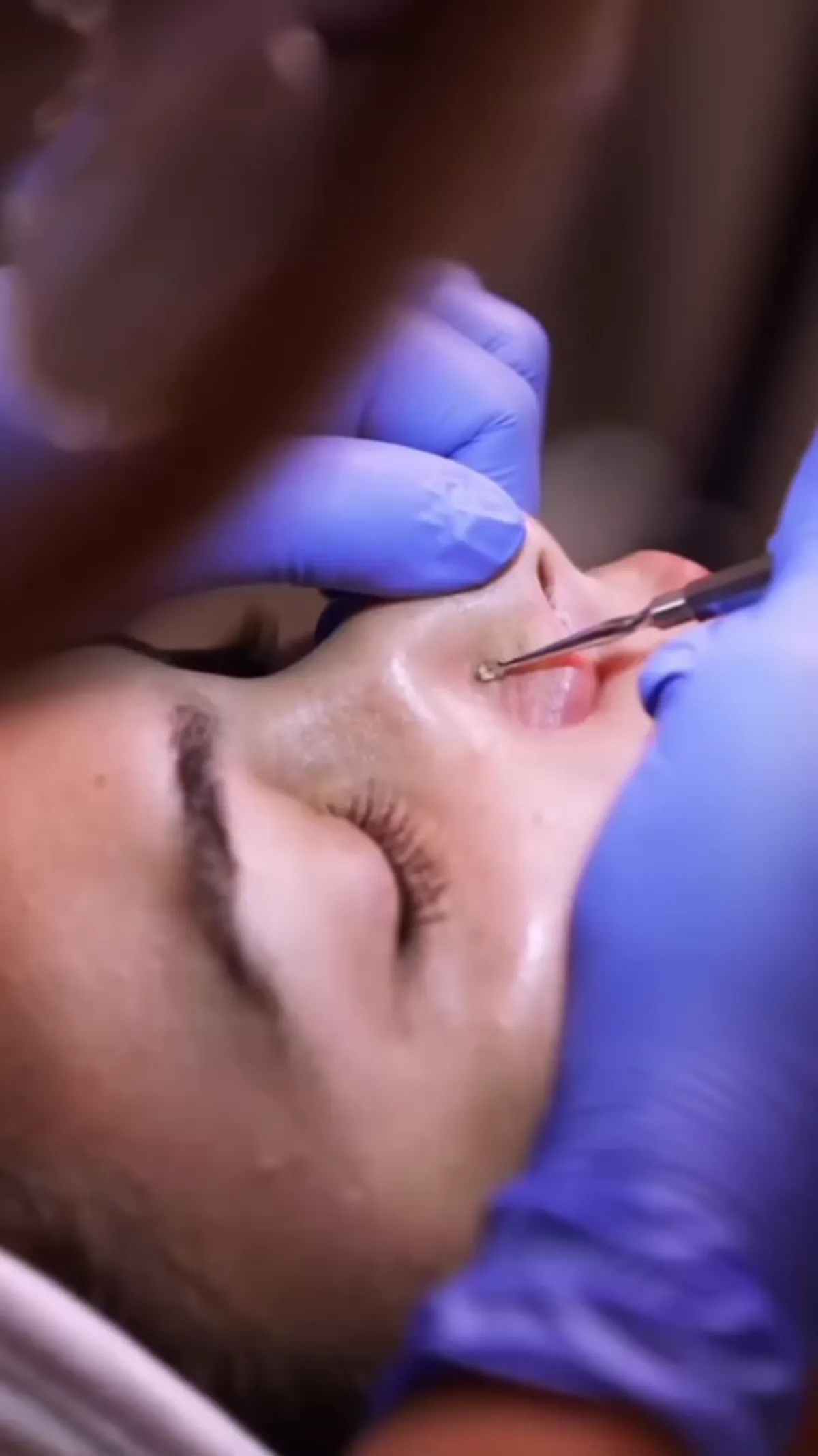 HydraFacial® treatment detail