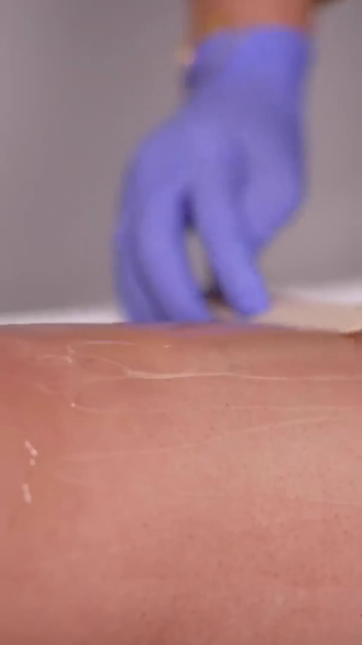 Laser Hair Removal treatment detail