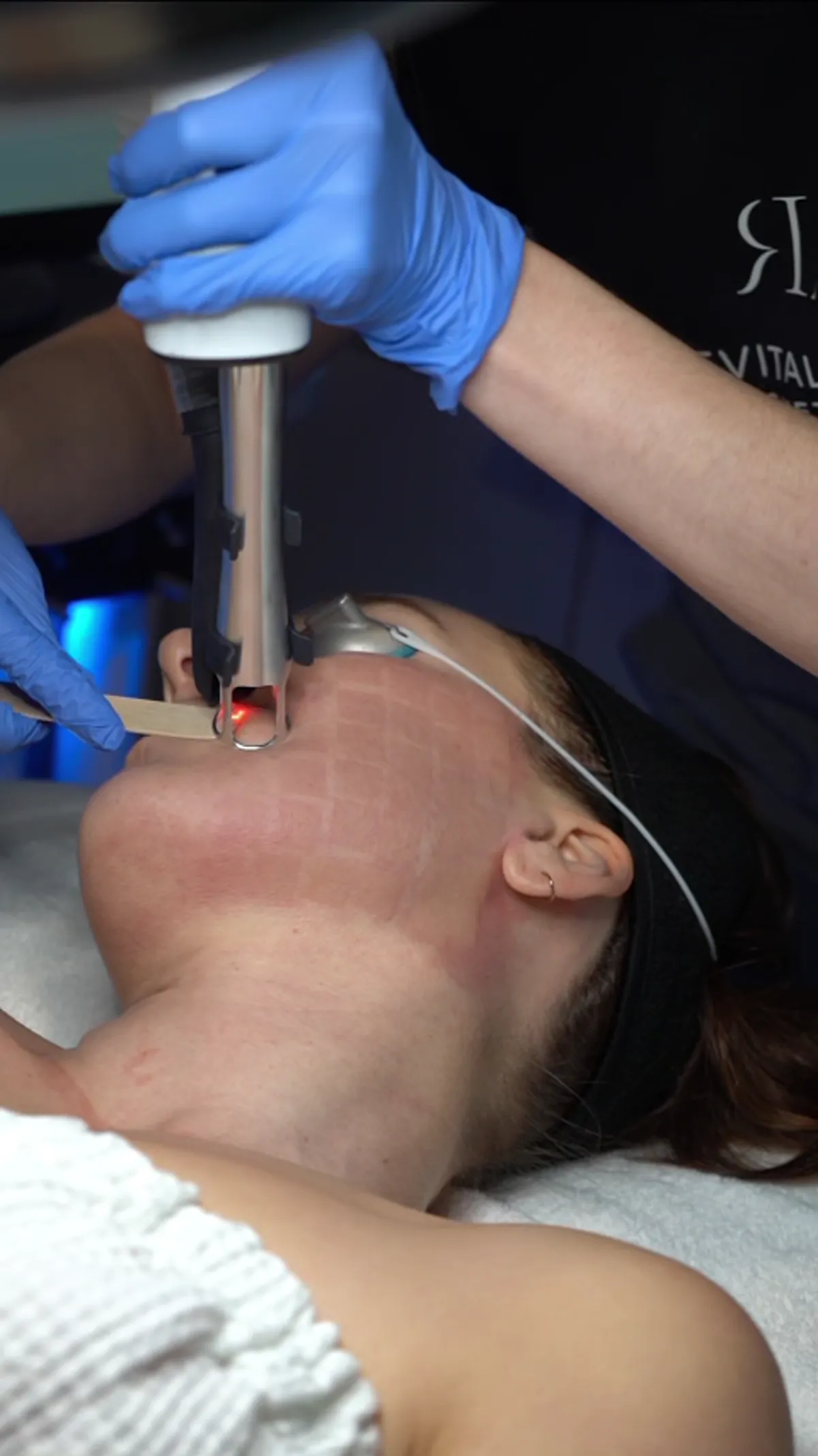 Lasers treatment