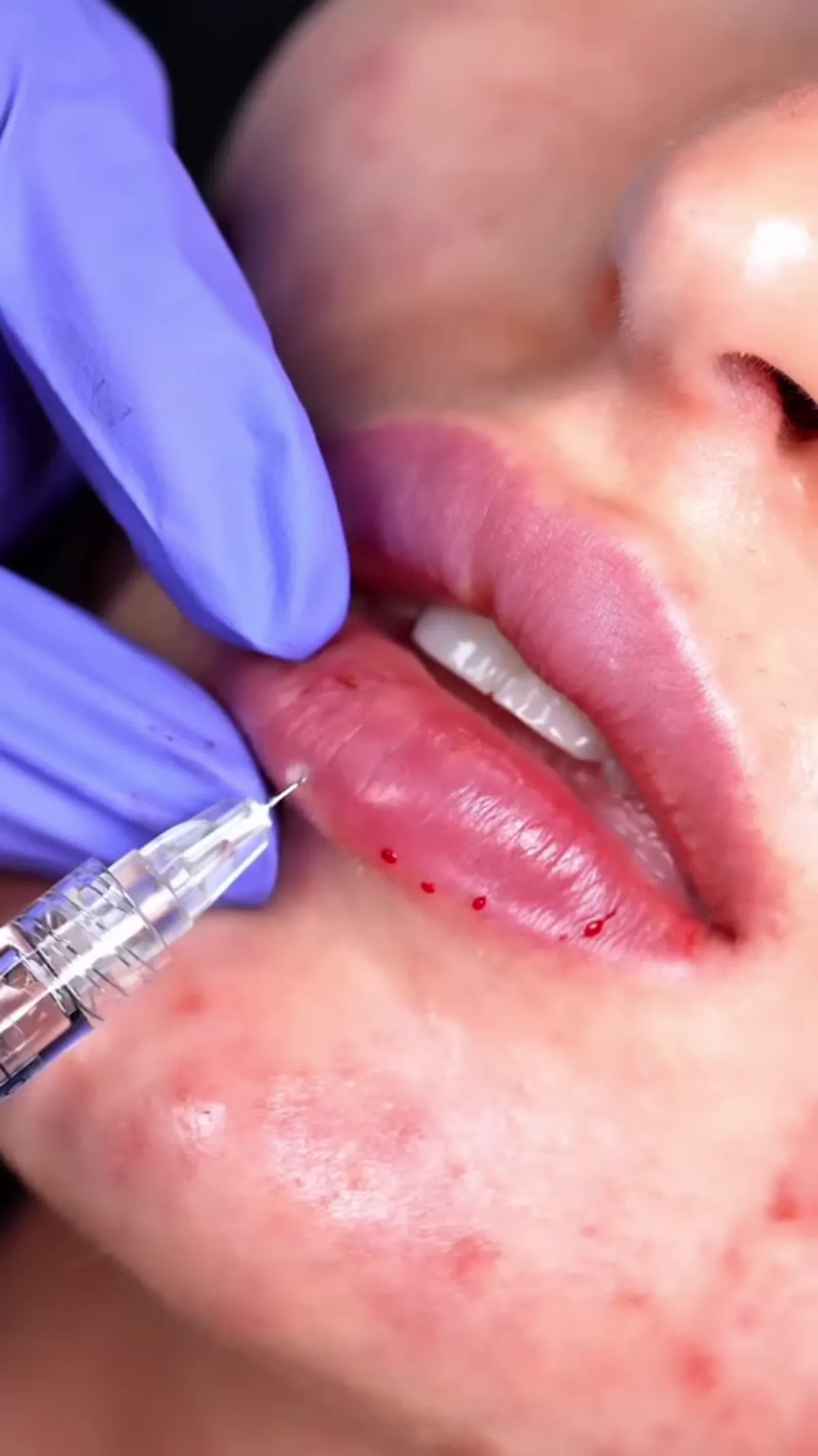 Lip Filler treatment