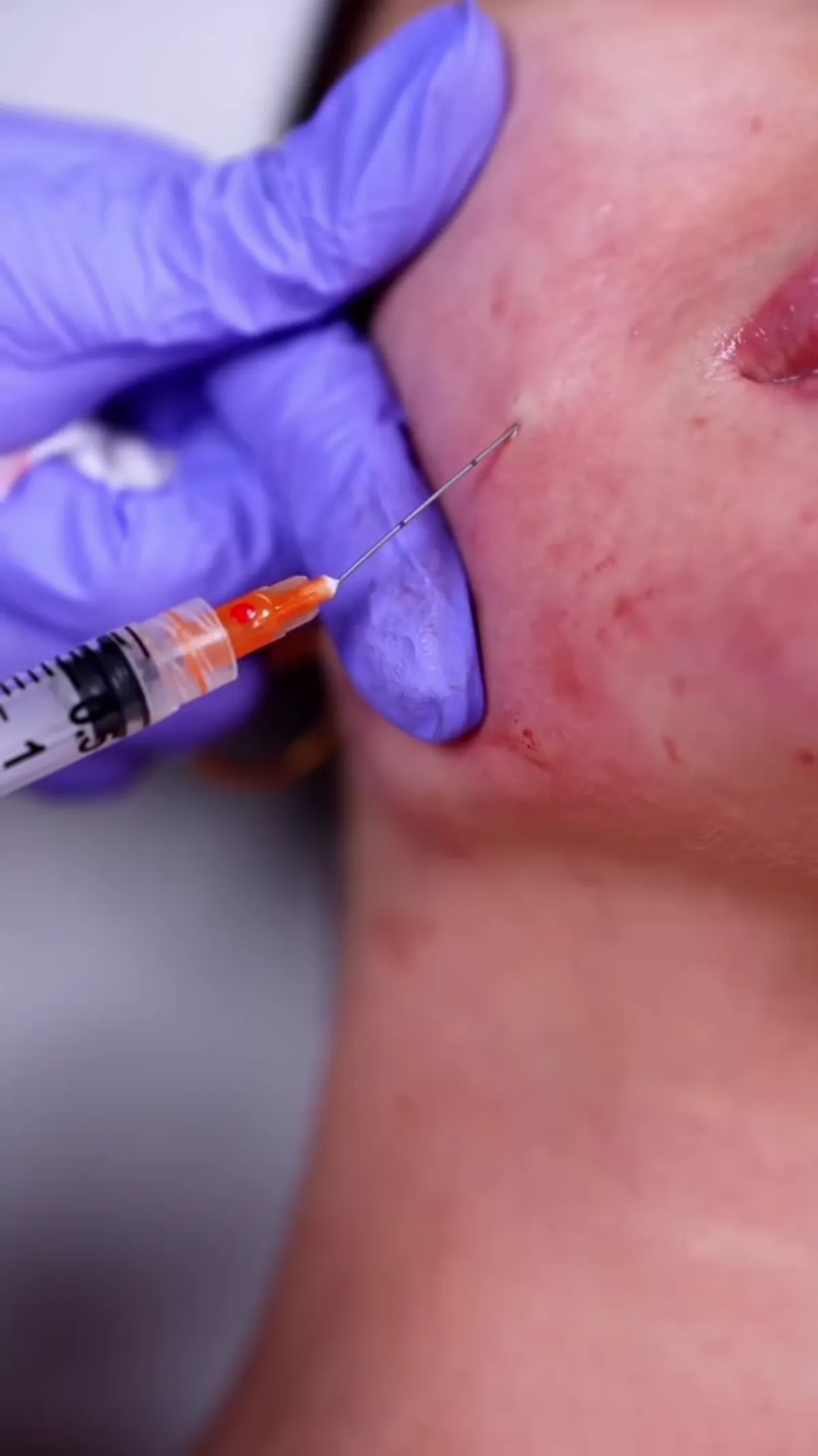 Sculptra® Glow treatment
