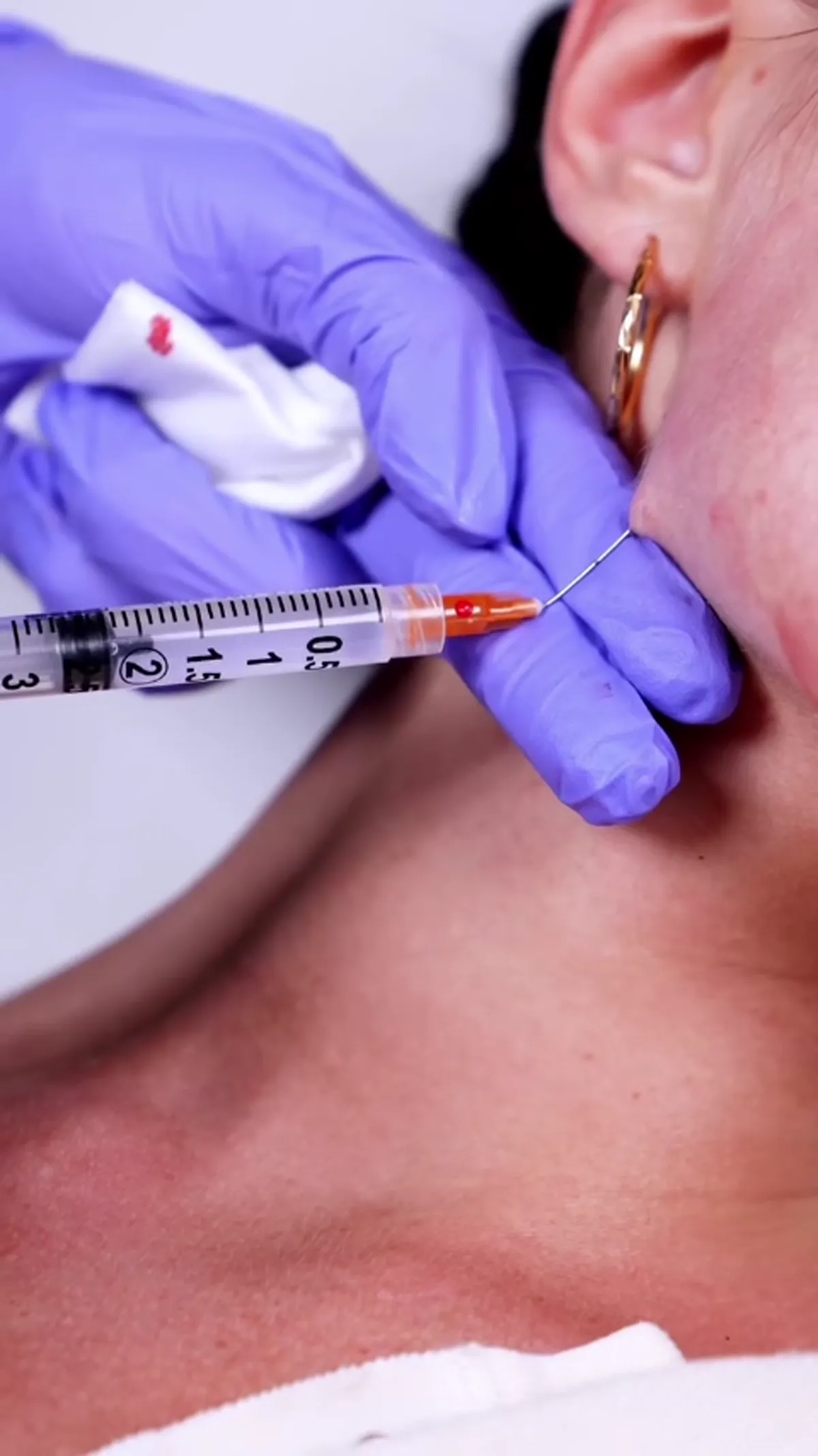 Sculptra® Glow treatment detail