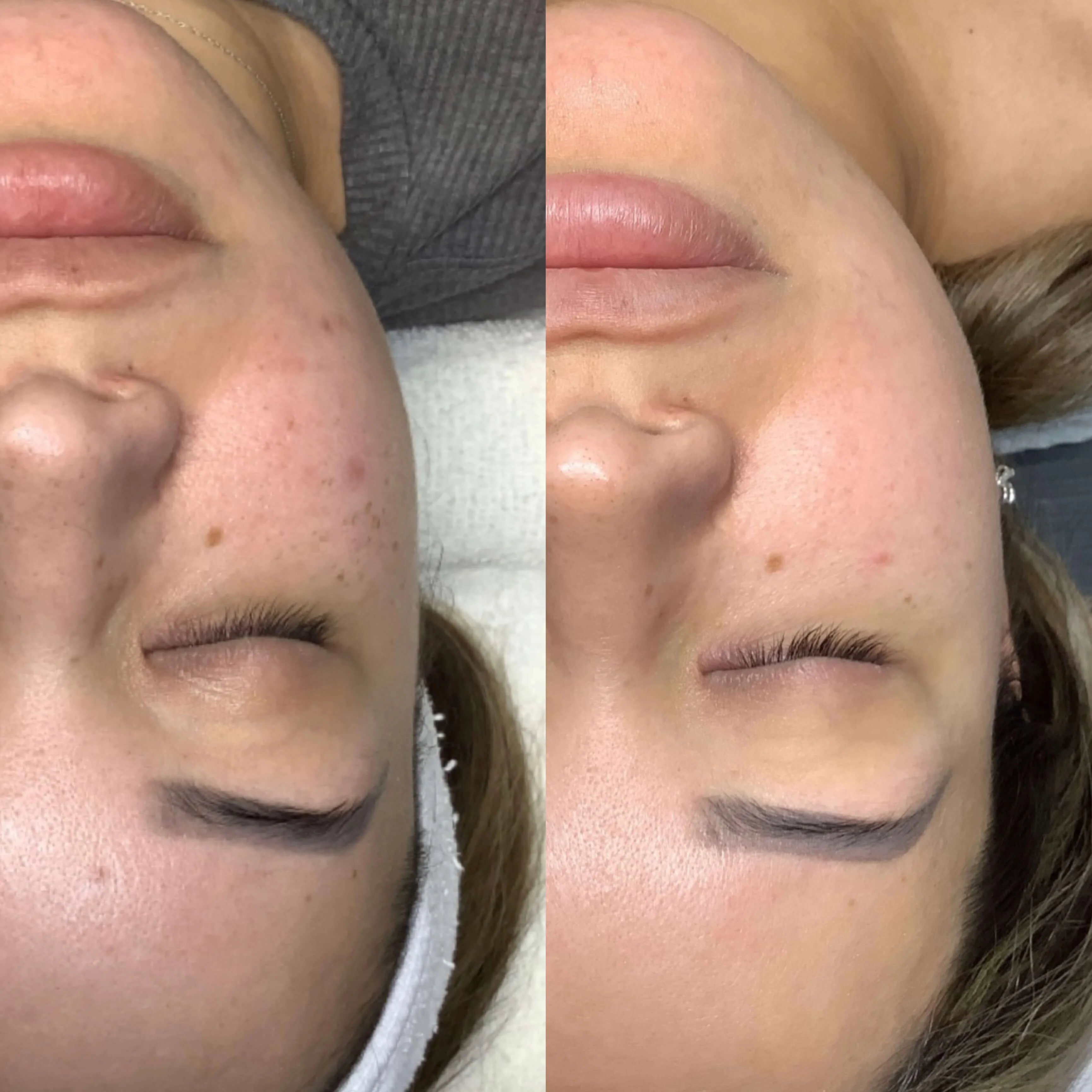 6 months after a series of 3 HydraIPL