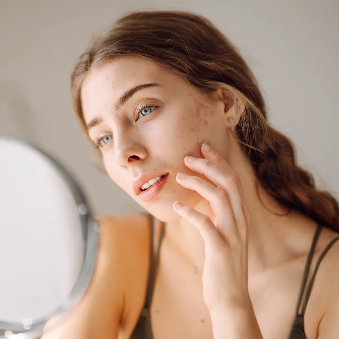 Chemical Peels for Acne Scars: Do They Really Work?