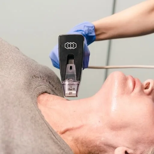 Morpheus8- RF microneedling