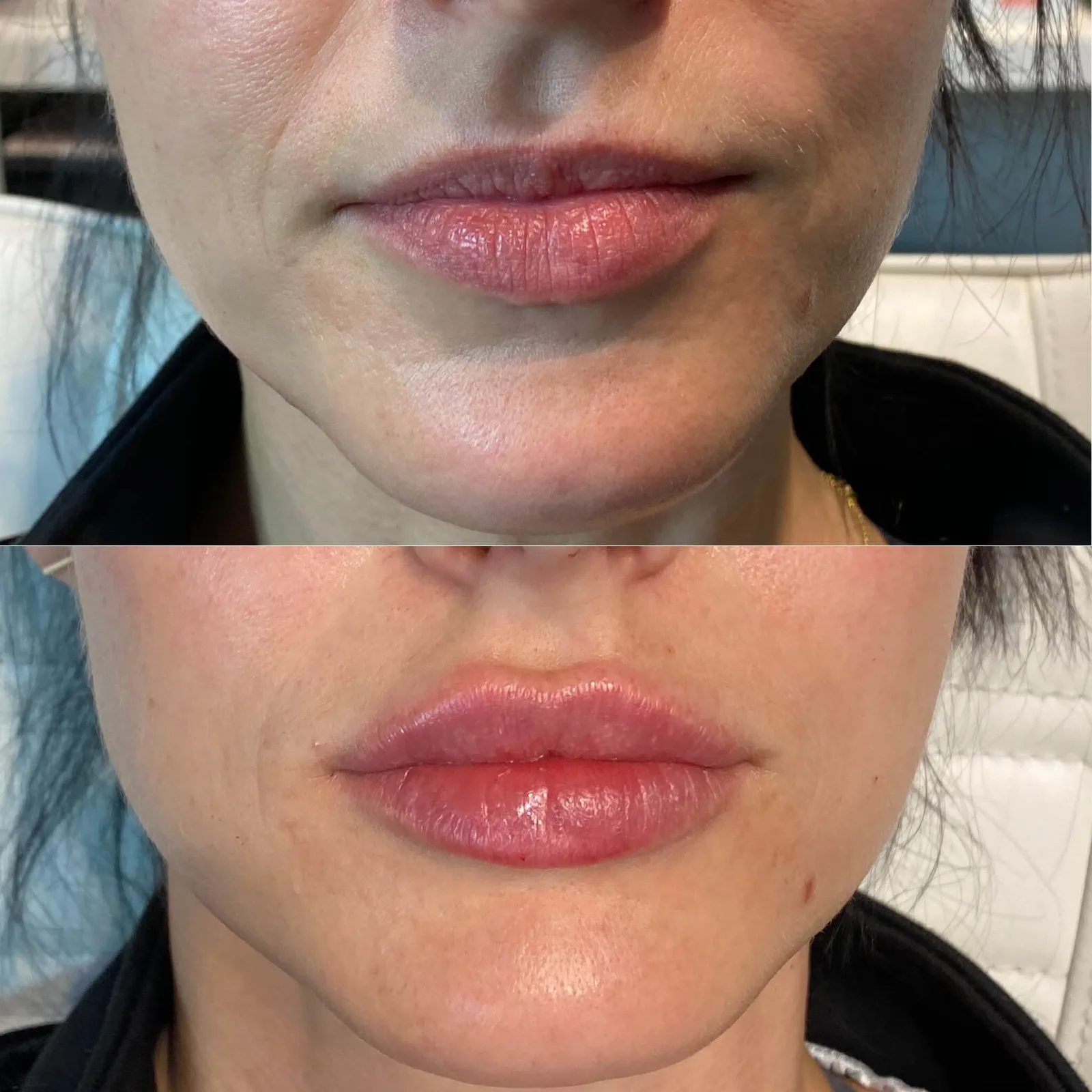 1mL of Restylane Kysse by Jessica Orman APRN,
