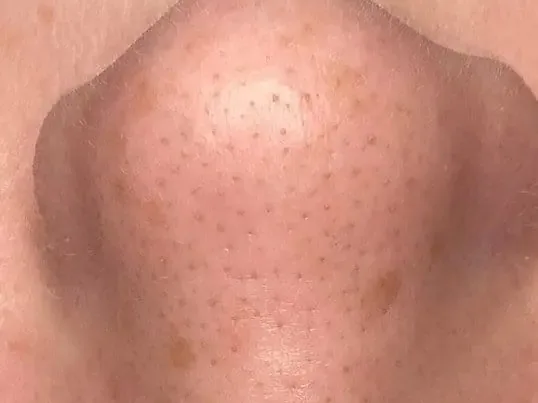 Clogged pores on the nose of a HydraFacial patient at the clinic. The photo shows the concern. It is not a chemical peel before.