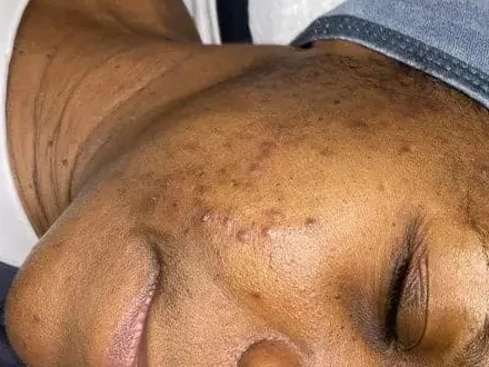 Dark marks on the cheek of an acne-treatment patient at the clinic. The photo shows the concern. It is not a chemical peel before.