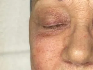 Uneven, sun-flushed color on the cheek of a chemical peel patient