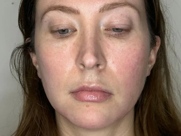 Front view of a facial balancing patient, with flat cheeks and a hollow under the eyes