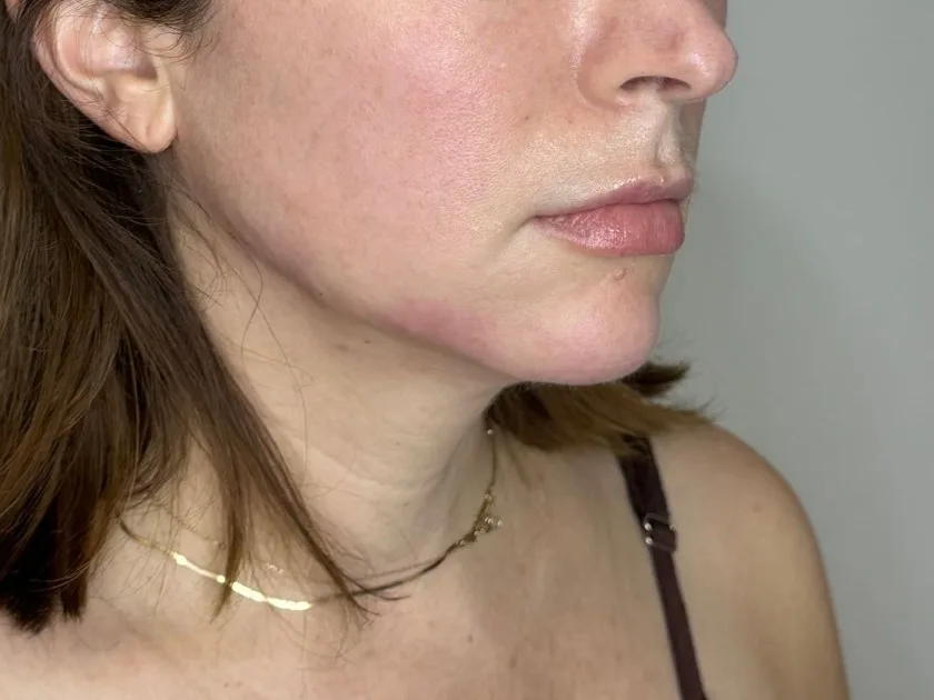 Side view of a facial balancing patient, where the jaw softens into the neck