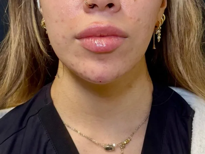 Lower face of a facial balancing patient, with the lips sitting forward of a smaller chin