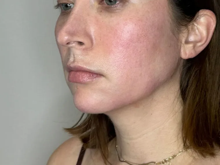 Side view of a facial balancing patient, with the chin sitting slightly behind the lips