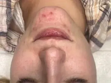 Small blemishes on the chin of a HydraFacial patient