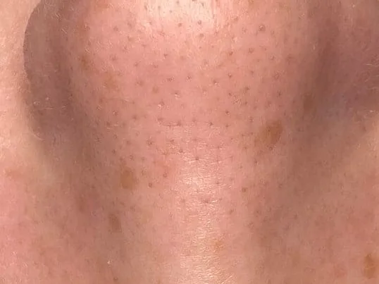 Blackheads across the nose of a HydraFacial patient