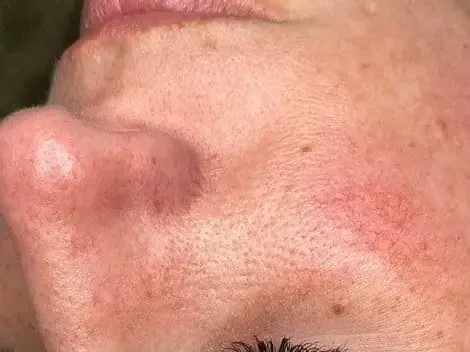 A flushed cheek on a HydraFacial patient