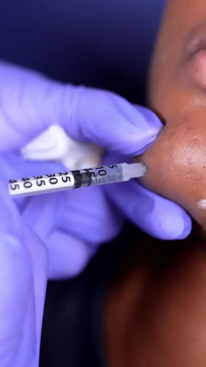 KYBELLA® treatment detail