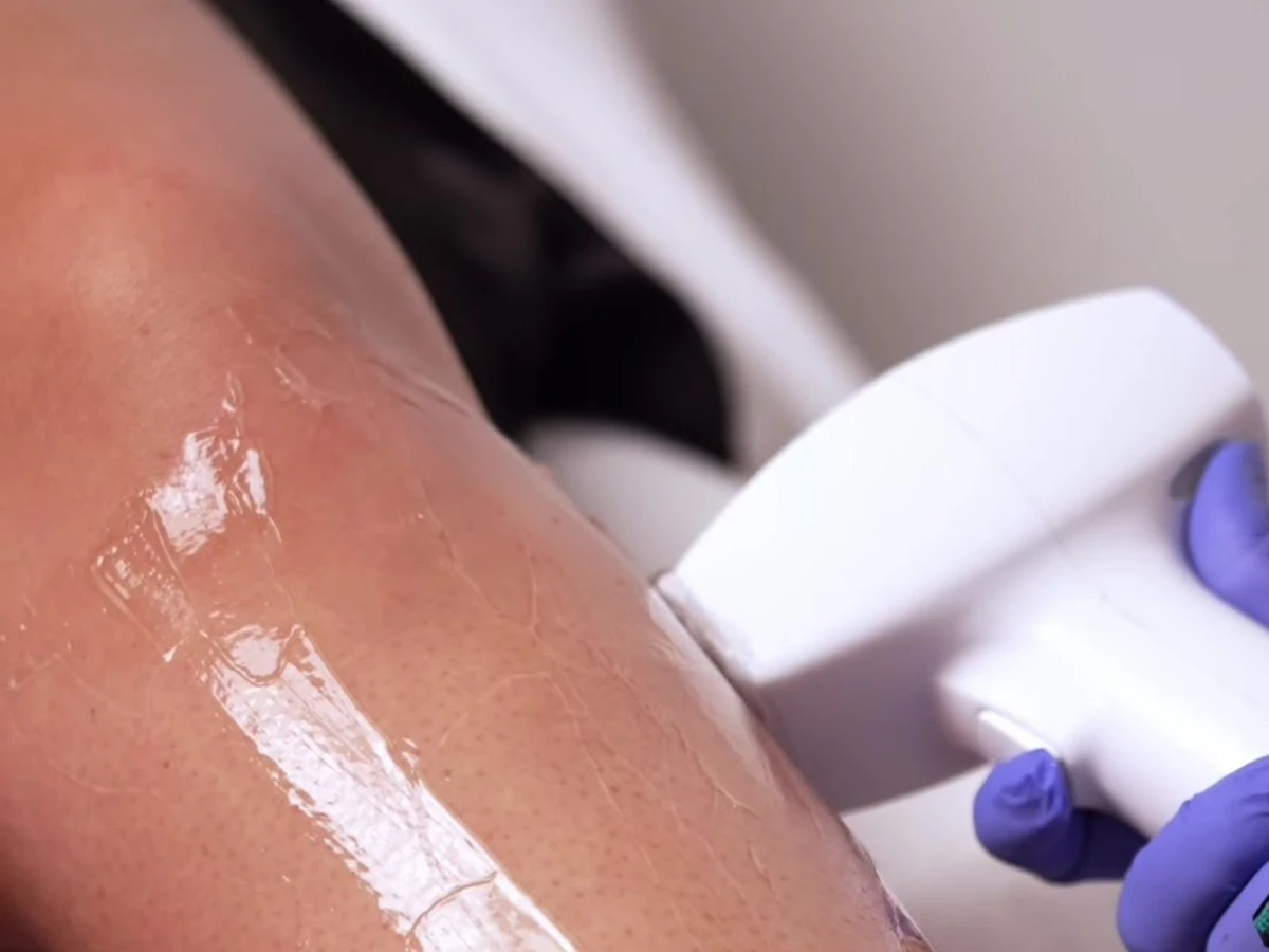 Laser handpiece on skin during a hair-removal visit