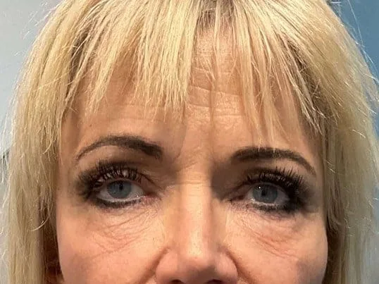 Fine lines at the forehead and outer eyes on a clinic patient