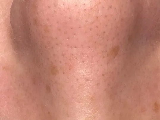 Visible pores across the nose of a clinic patient