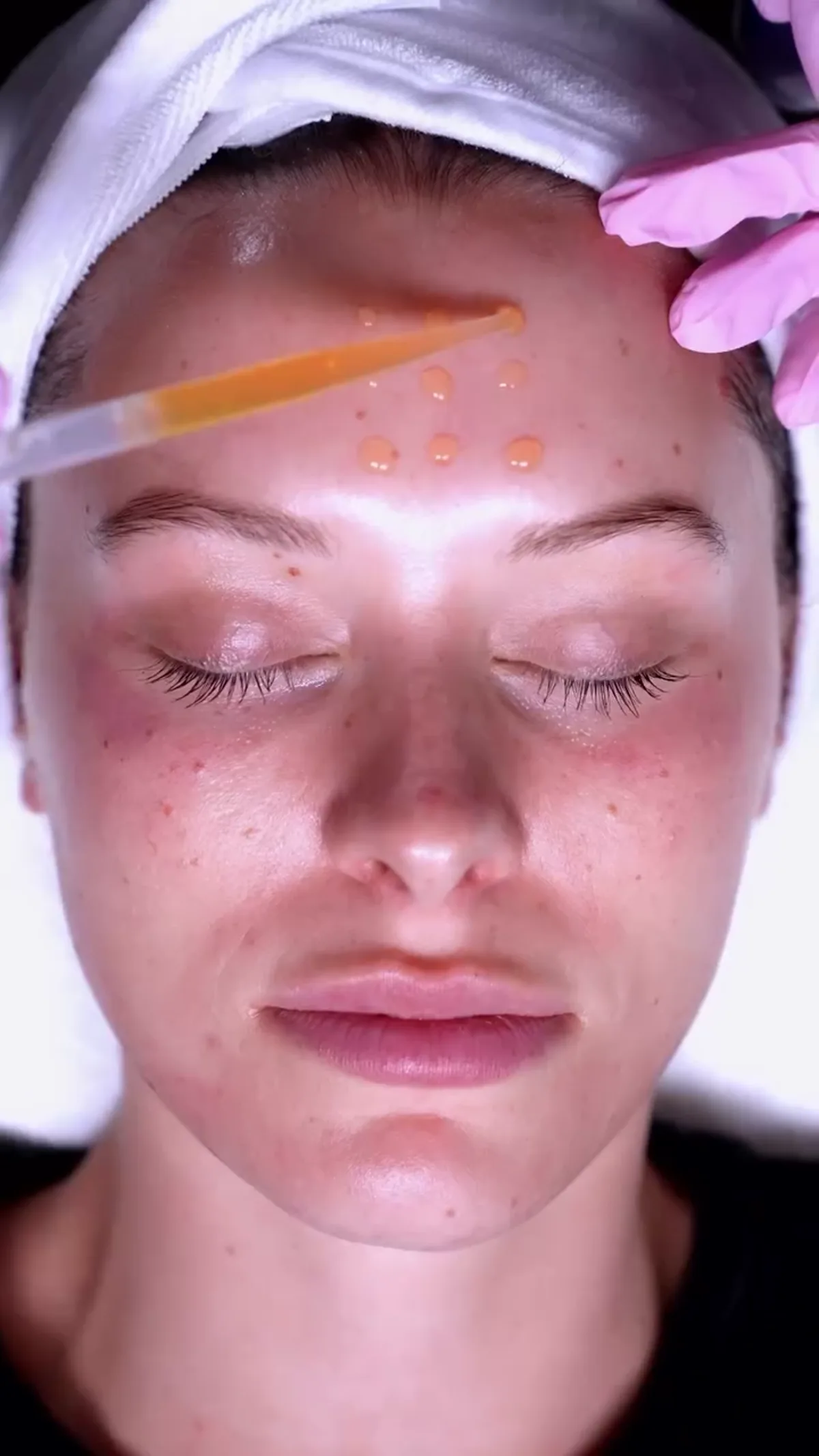 Laser Stretch Marks treatment detail
