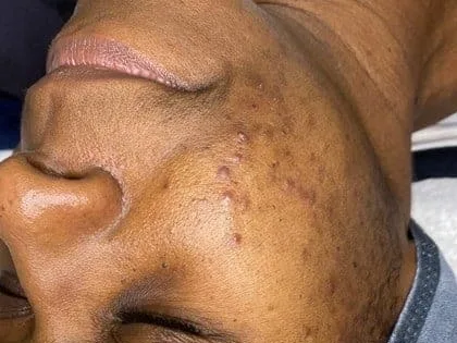 Pitted scars on the cheek of an acne-treatment patient at the clinic. The photo shows the concern. It is not a Morpheus8 before.