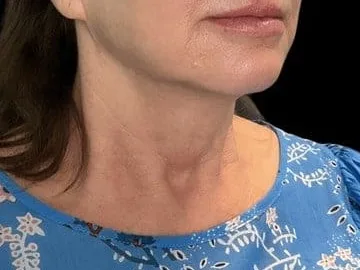 Softening along the jaw and creases on the neck of a Sculptra patient at the clinic. The photo shows the concern. It is not a Morpheus8 before.