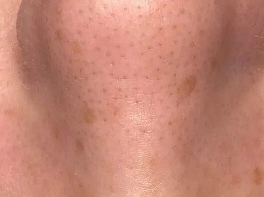 Visible pores on the nose of a clinic patient. The photo shows the concern. It is not a Morpheus8 before.
