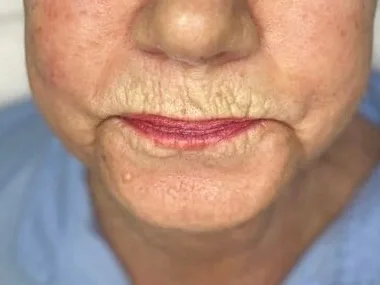 Crepey lines around the mouth of a chemical peel patient at the clinic. The photo shows the concern. It is not a Morpheus8 before.