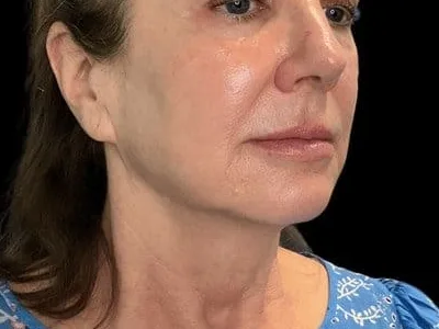 A flatter cheek on a clinic patient. On this plan, Sculptra was used in the temples. The photo shows the concern. It is not a Sculptra result.