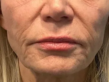 A thinner lower face, with lines around the mouth, on a Sculptra patient