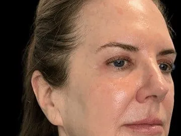The temple beside the eye on a Sculptra patient