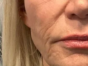 Thin, crepey skin along the cheek and mouth of a Sculptra patient